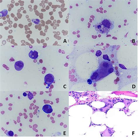 Cureus Neutropenic Fever In A Patient With Sars Cov 2 Induced