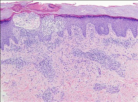 Experience With Molluscum Contagiosum And Associated Inflammatory