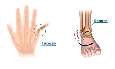 Diferença Entre Entorse E Luxação