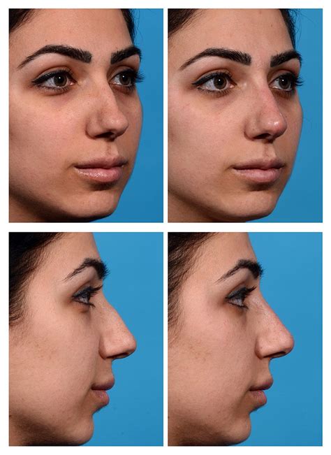Fillers For Nose Before And After Injectable Nose Job Rhinoplasty