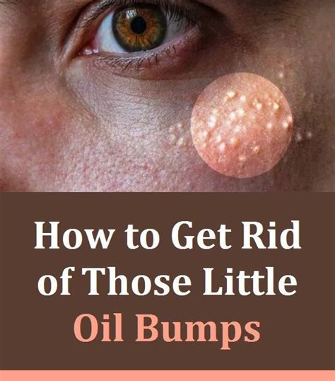 How To Get Rid Of Bumps On Face How To Get Rid Of Bum