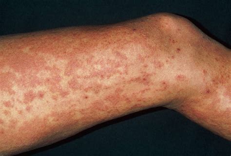 Overview Of Hives Or Urticaria
