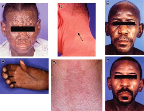 Clinical Manifestations Of Scleromyxedema A B Patient 8 Most Severe