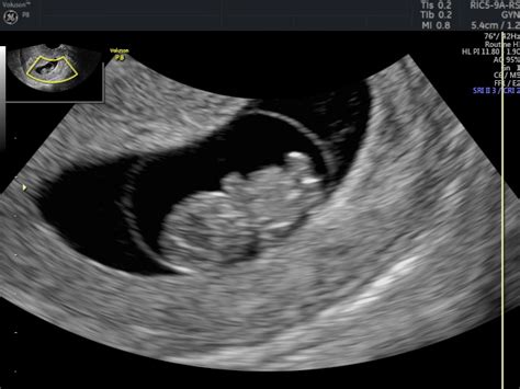 Early Pregnancy Scan Private One On One Pregnancy Fertility
