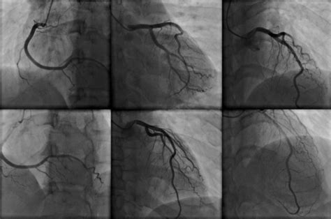 Cardiac Catheterization Beverly Hills Coronary Angiogram