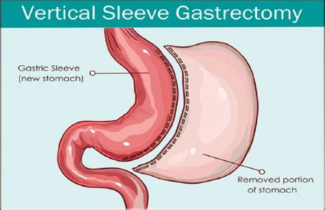 Gastric Sleeve What Is It Symptoms Causes Prevention Healthys Life