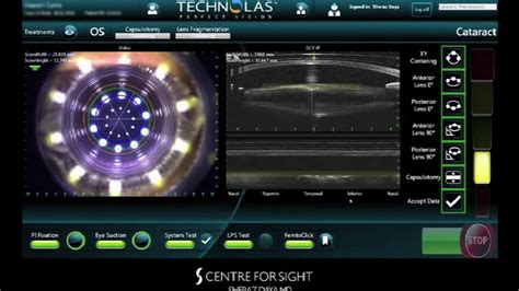 Victus Femtosecond Laser Cataract Surgery And Translens Hydrodissection