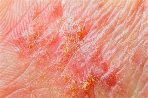 Dyshidrotic Eczema Also Known As Pompholyx Or Cheiropompholyx In The
