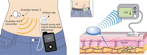 a hybrid closed loop insulin delivery system for the treatment of type i diabetes