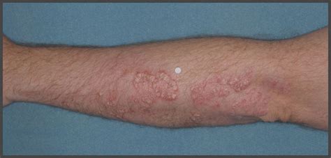 Pictures Of Plaque Psoriasis On Arms Psoriasis Expert