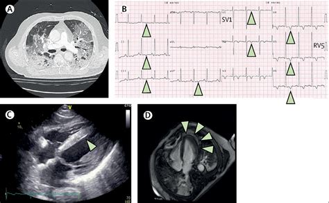 Myocarditis In A Patient With Covid 19 A Cause Of Raised Troponin And