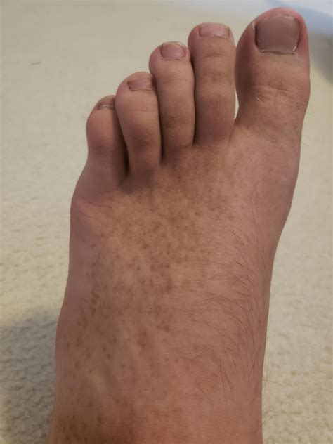 What Are These Brown Spots On My Foot R Medical