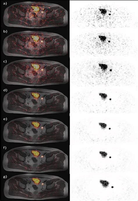 Image Quality Of 68ga Hbed Cc Psma Petmri Of A Patient With Recurrent