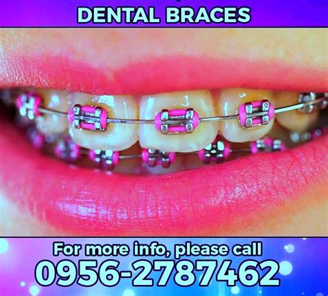 Gold Braces Are Now The Rage The Brace Orthodontic Practice