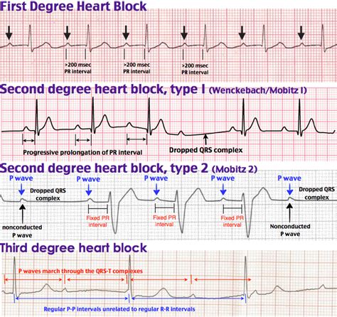 Rosh Review Heart Blocks Cardiac Nursing Second Degree Heart Block