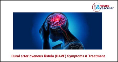Dural Arteriovenous Fistula Davf Symptoms And Treatment