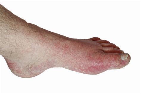 Can Gout Occur In The Ankle