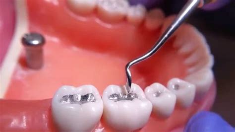 the history of dental amalgam. What Is Amalgam? - Holistic Dentist Phoenix | Phoenix ...