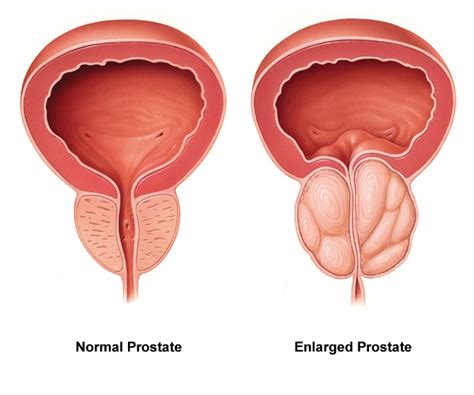 All You Need To Know About Enlarged Prostate Bph