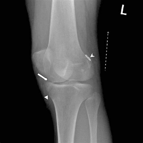 B Lateral Oblique Knee View Moderate Joint Effusion Is Detected In The