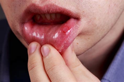 Cold Sores Vs Canker Sores Their Causes And Fivewondrous Natural Cures