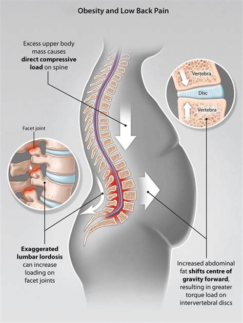 Belly Fat Can Cause Back Pain And Injury Injury Medical Chiropractic