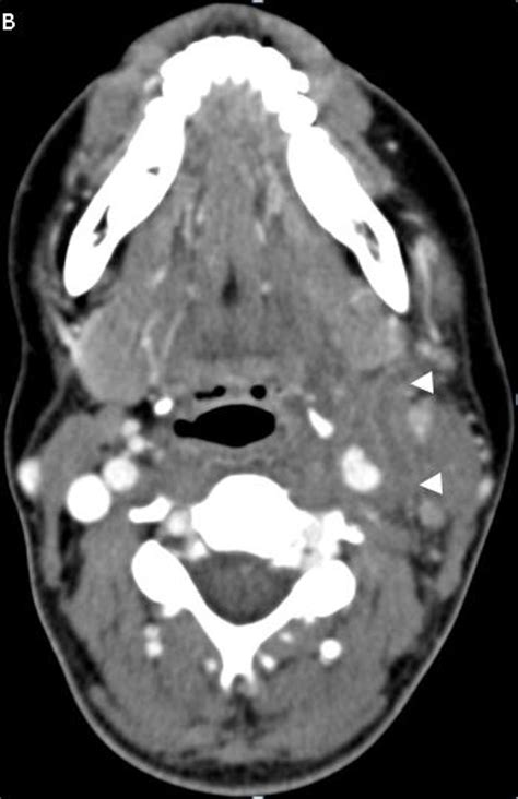 Ct Venogram Of The Neck Ct Image Shows Occlusion Of The Left Internal