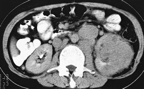 Renal Cell Carcinoma Ct Sumers Radiology Blog