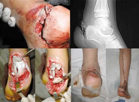 You can see a diagram of the achilles tendon below. Figure Deep posterior heel laceration, severed Achilles ...