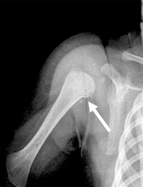 The Same Patient As In Fig 1 Anteroposterior Radiograph Of The Right