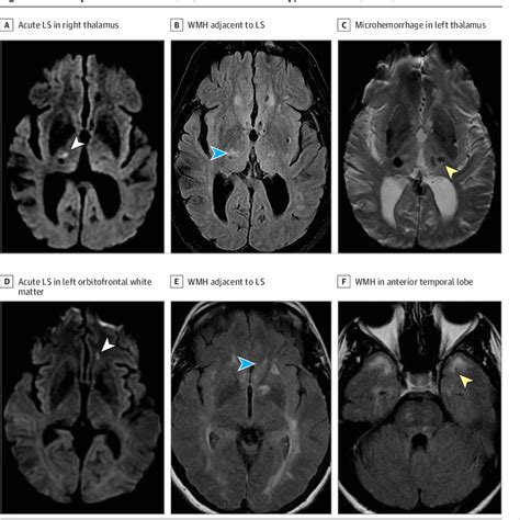 Advances In Understanding The Pathophysiology Of Lacunar Stroke A