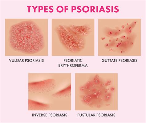 the ultimate guide to psoriasis what causes it and how to treat it blog huda beauty