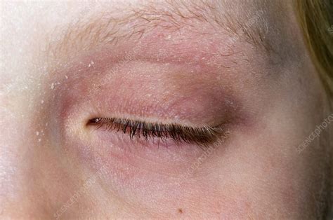 Eczema Around The Eye Stock Image C0142676 Science Photo Library