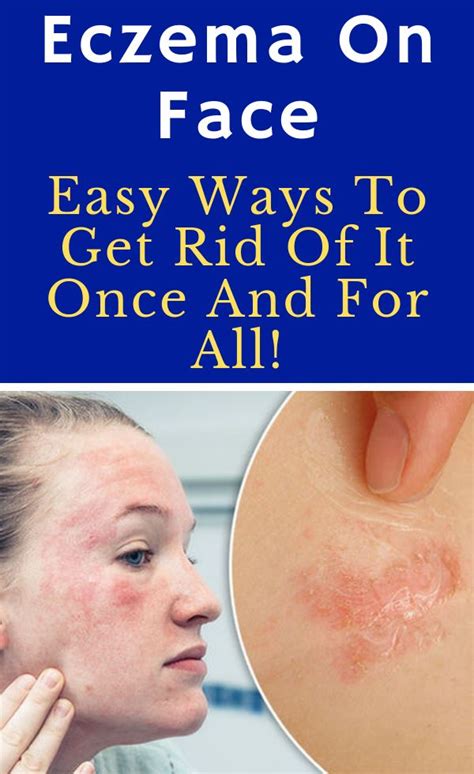 Eczema On Face Easy Ways To Get Rid Of It Once And For All Eczema