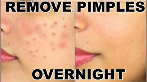 How To Remove Pimples Overnight Acne Treatment Fitness