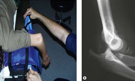 Acute Elbow Dislocations And Management Clinical Gate