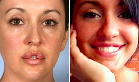 The Most Shocking Botched Plastic Surgery Transformations Life And Style