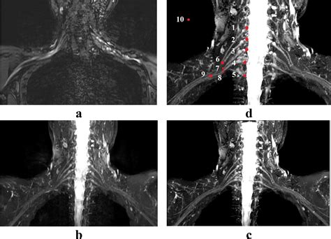Non Contrast Enhancement Of Brachial Plexus Magnetic Resonance Imaging