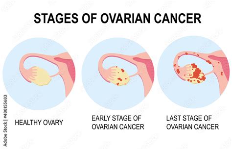 Diagram Showing Stages Of Ovarian Cancer Illustration Pelvic Cancer