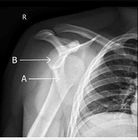 Shoulder Joint X Ray