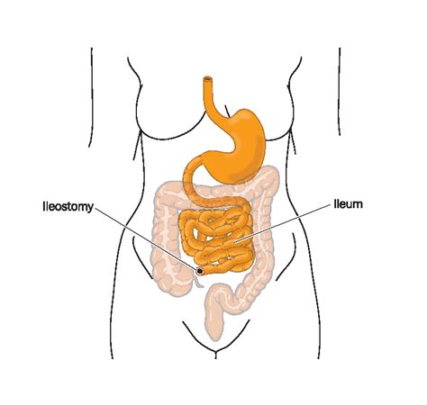 Ileostomy Information L United Ostomy Associations Of America