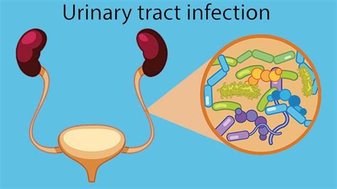 Makalah anatomi fisiologi sistem urinaria kesehatan lingkungan. E. coli and Urinary Tract Infections (UTIs) | Everyday Health