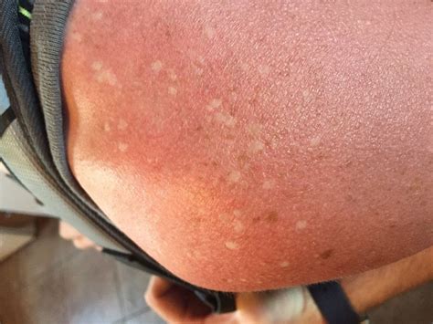 White Spots On Skin From Sun Exposure How To Prevent And Treat