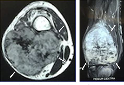 Figure 1 From Surgery On Aggressive Fibroma Of The Posterior