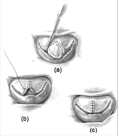 A Surgeons View Of The Mitral Valve Demonstrating A Tall