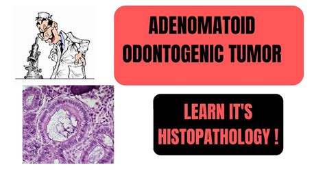 Adenomatoid Odontogenic Tumoraot Part2 Learn Its Histopathology I