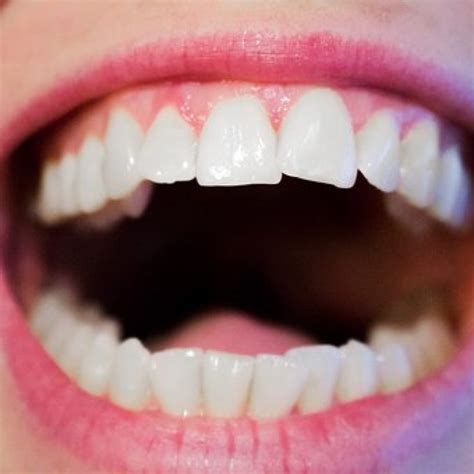 Tips For Healthy Teeth And Gums Simcoe Smile Dental