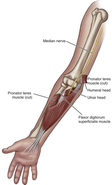 Pronator Teres Syndrome Symptoms Causes Treatment Exercises