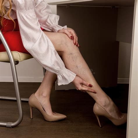 Painful Varicose And Spider Veins On Female Legs Woman Massaging Tired Leg Stock Photo Image