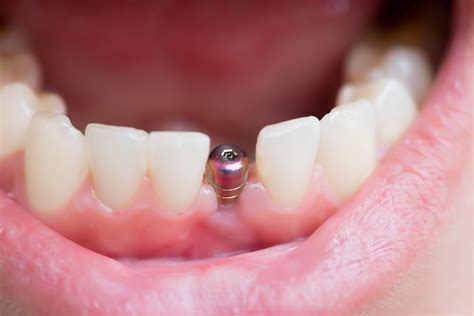 Front Teeth Dental Implants Austin Tx 38th Street Dental